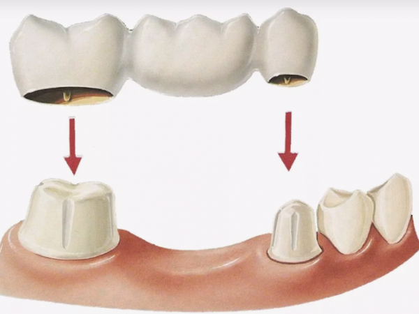 Съемные зубные протезы: Перспективы и альтернативы
