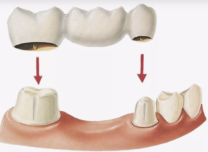 Съемные зубные протезы: Перспективы и альтернативы
