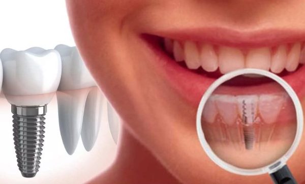 Путь к новой улыбке: подробный гид по этапам имплантации зубов