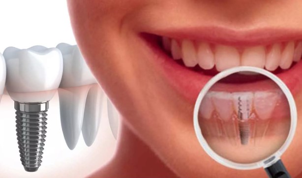 Путь к новой улыбке: подробный гид по этапам имплантации зубов