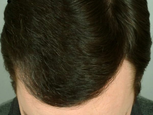 Возвращая утраченные волосы: плюсы пересадки волос